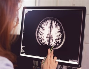 Neck scan detects dementia way before symptoms appear