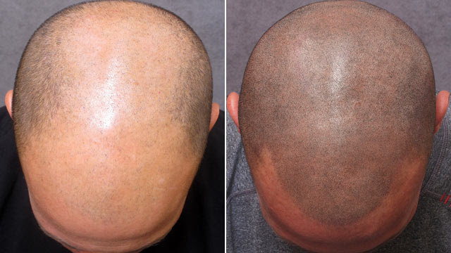 You might have heard about the new hair growth helmet that is being launched from a. Considering A Hair Tattoo Pros And Cons To Consider Before You Commit Abc News
