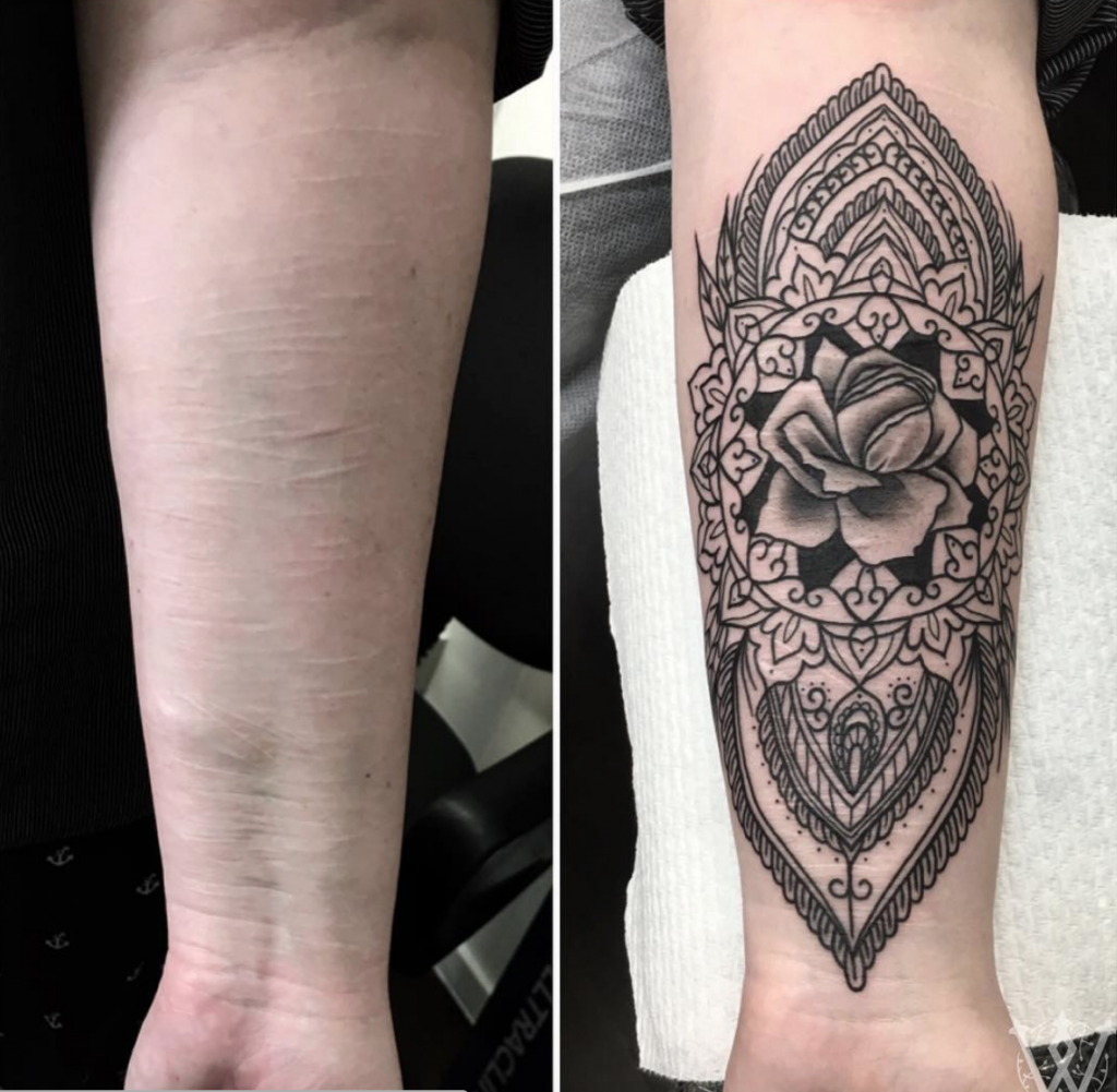 Tattoo Artist Specializing In Scar Cover Up Near Me