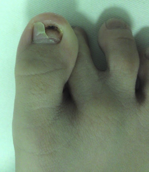 The medical name for a detached nail that eventually falls off is onycholysis and this can affect toenails and fingernails. All About Your Child 2010 September