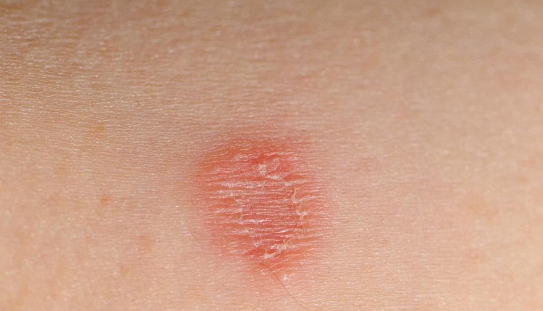 Fungal Skin Rash Pictures