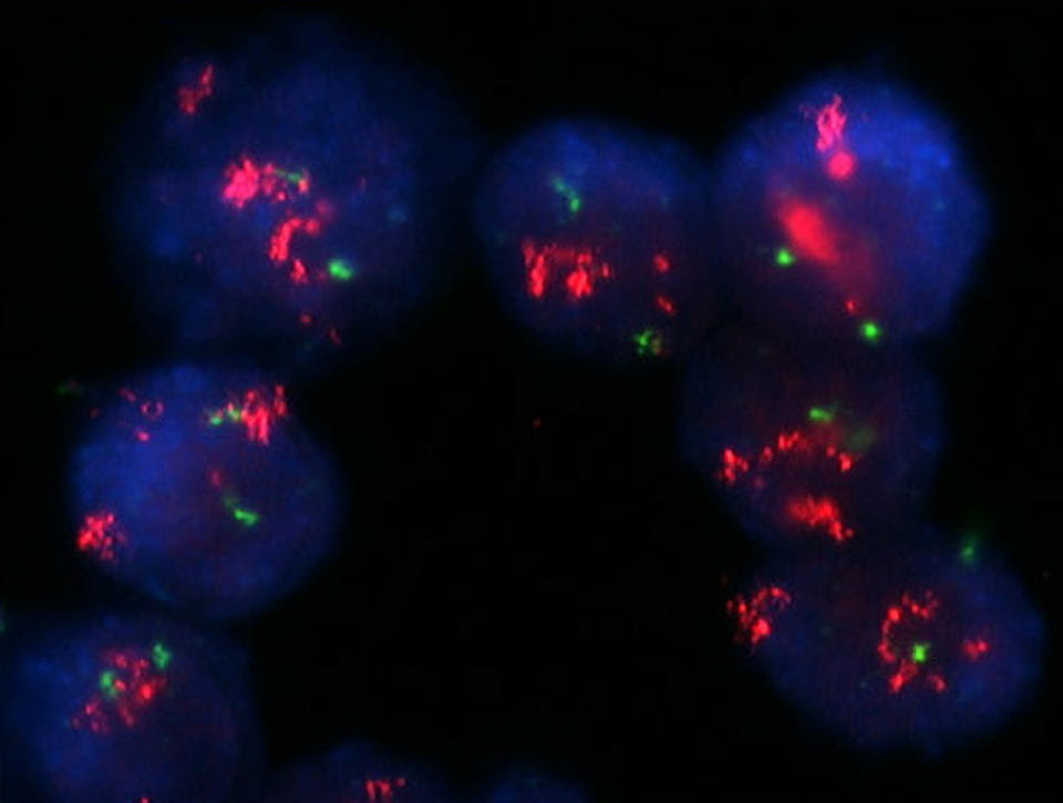 Breast cancer cells with strong HER2 amplification (shown in red) that have spread to the lymph nodes.