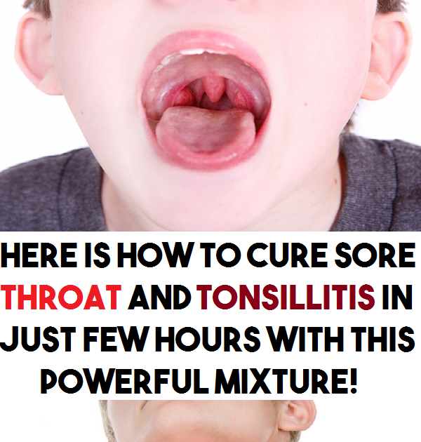 How To Cure White Spots In Throat