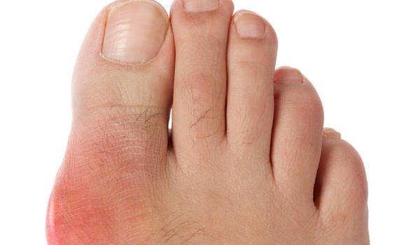 Pokok Ubat Sakit Gout - Dawn Hullender
