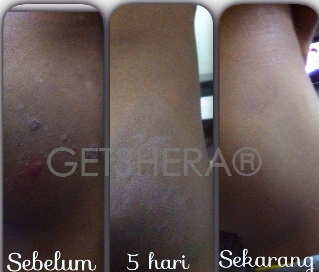 Ubat Eczema Untuk Bayi - Lamaran M