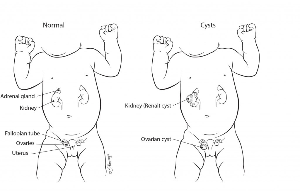 Can you have a child with an ovarian cyst Baby Corner