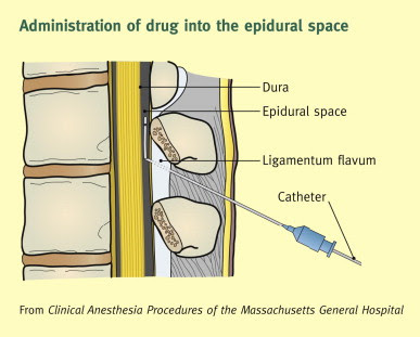 CERITA CERITI: Bersalin dengan Epidural