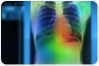 Researchers develop novel and promising approach for treatment of lung cancer