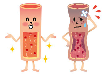 新着動脈 硬化 イラスト ディズニー画像のすべて