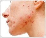 Study explores pregnancy-related adverse events associated with acne medication