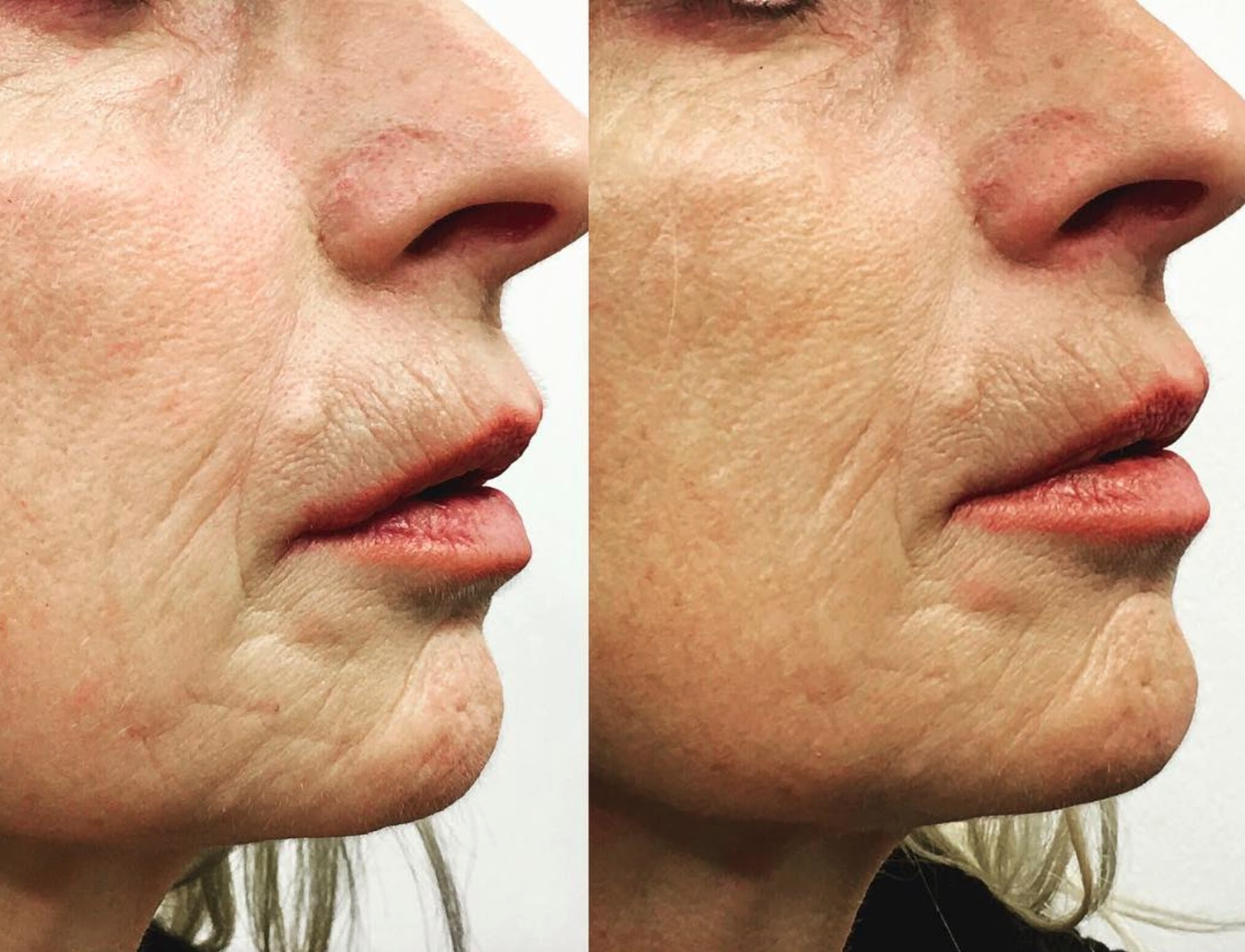 If you are really shedding that badly i would follow up with the person who performed your treatment and let. Micro Needling Simplyskin Medical Aesthetics