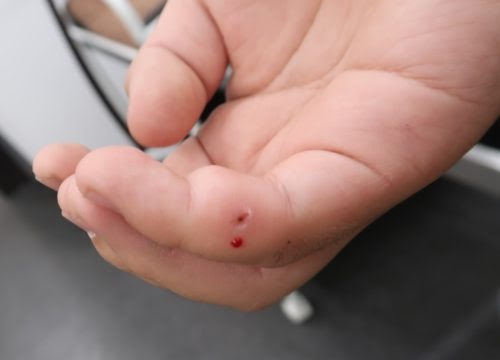 手にトゲが刺さった 手にトゲが刺さった