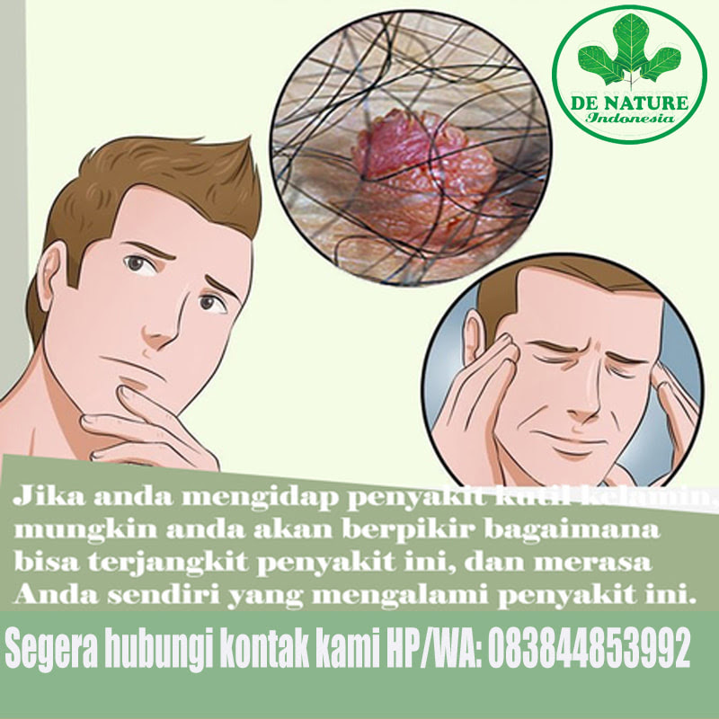 Ubat Untuk Kutil - Contoh Omo