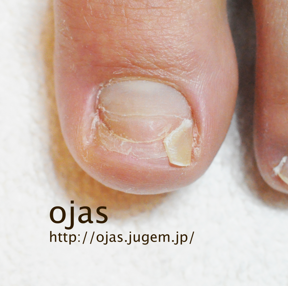 ネイル 亀裂 補強 ネイルアート最高の画像