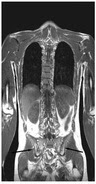 SpondyloArthritis