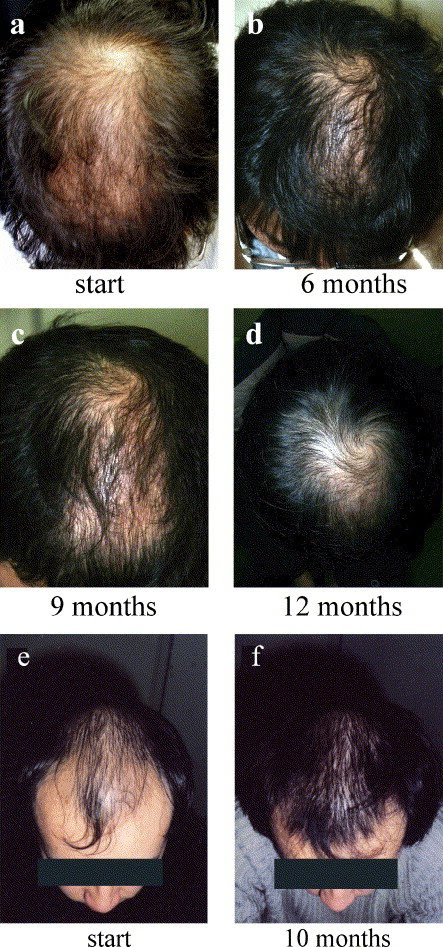 Miconazole For Hair Growth