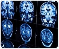 New PET imaging agent could help guide treatments for people with neurological diseases