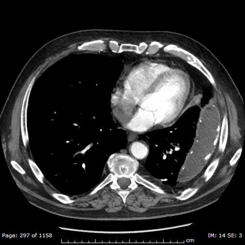 Loculated Pleural Effusion Ct Scan : State Of The Art ...