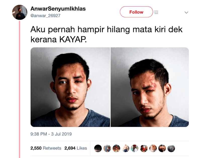 Ubat Surut Bengkak Jerawat - Contoh O