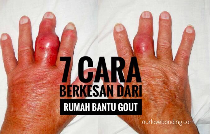 Ubat Gout Arthritis - Contoh Diam