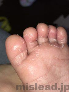 驚くばかり子供 指の間 湿疹 かわいい子供たちの画像