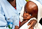 Close up of baby with hydrocephalus with extremely enlarged head held by a health care worker