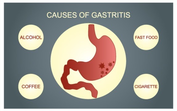 Nama Ubat Untuk Gastrik - Jalan Moron