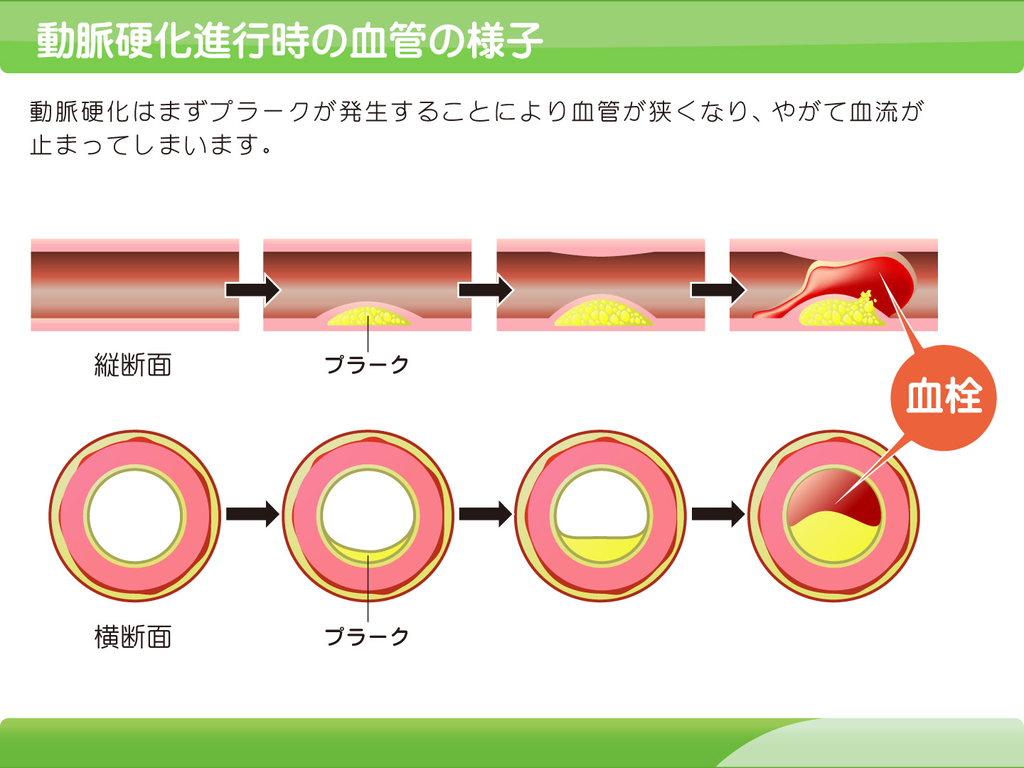 最高の無料イラスト ベスト動脈硬化 血管 イラスト 無料