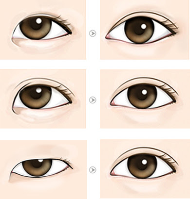 When an upper eyelid is absent, it is called single eyelid. Teuim Aesthetic Plastic Surgery Clinic