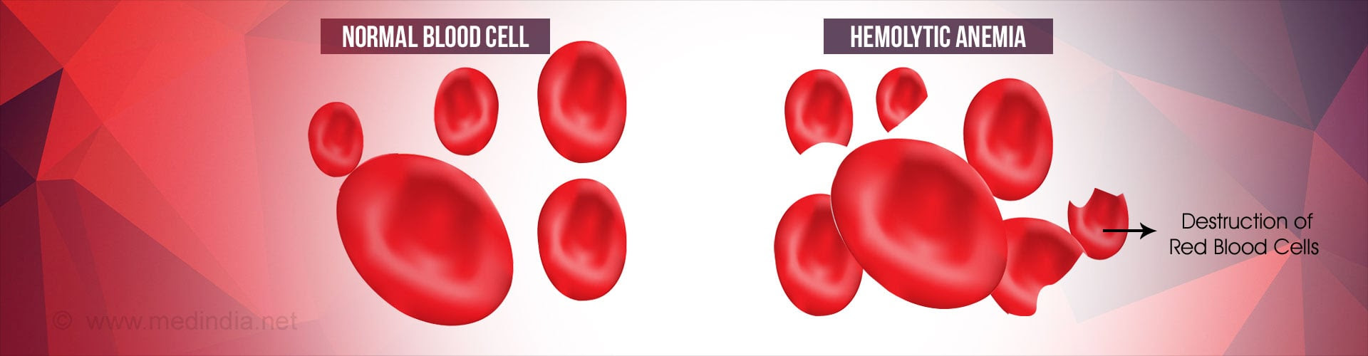 Image result for  Destruction Of Red Blood Cells 