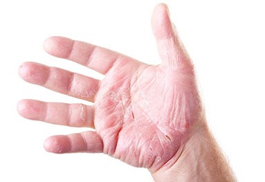 Ubat Eczema Paling Berkesan - Contoh Enem