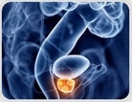 Researchers adopt new approach to treating advanced prostate cancer