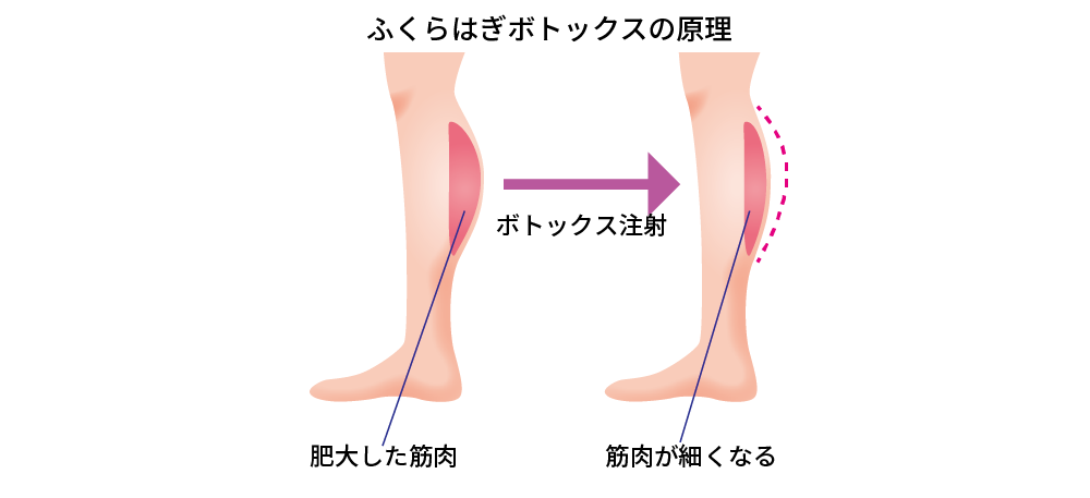 Testter ふくらはぎ 筋肉 レーザー