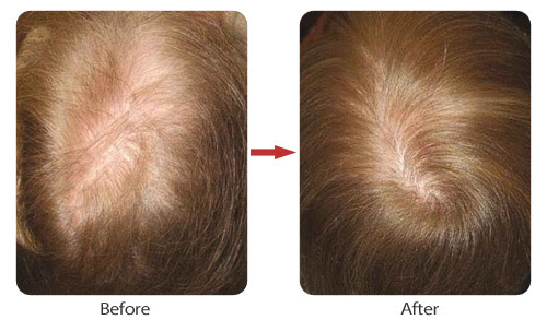 The method utilizes photons, which are irradiated into scalp tissues and absorbed by weak cells in order to encourage hair growth. Spectrum Salon And Spa Laser Hair Growth