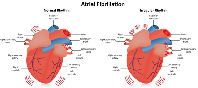 Low-carb diets linked to atrial fibrillation