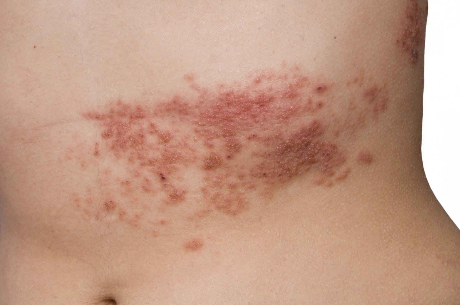 Det hårt pressade flygbolaget skriver i ett pressmeddelande att bokningarna ökar inför sommaren och hösten. Baltros Herpes Zoster Orsaker Symtom Och Behandling Medicinsk