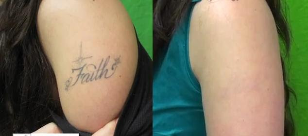 If your skin is white then its will be a. Tattoo Removal Process Painful Fast Home Tattoo Removal