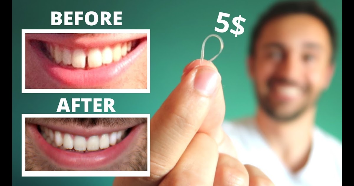How To Fix Gap Teeth At Home Teeth Gaps Can They Be